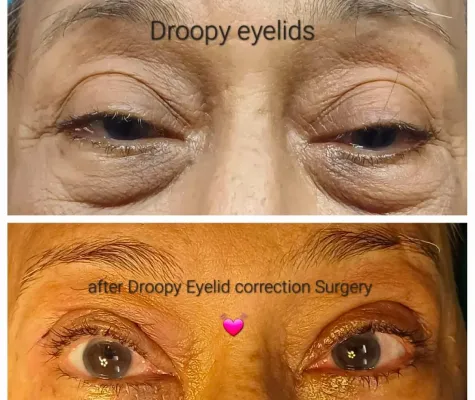 What is Orbit and Oculoplasty?